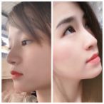 Top 4 Địa chỉ nâng mũi S-line đẹp và an toàn nhất TP. HCM