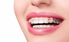 Top 9 địa chỉ niềng răng uy tín nhất TP. Vinh, Nghệ An.