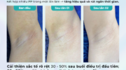 Review Dr. Choice Clinic: Trị Thâm Nách/Bẹn Có Hiệu Quả Không? 5