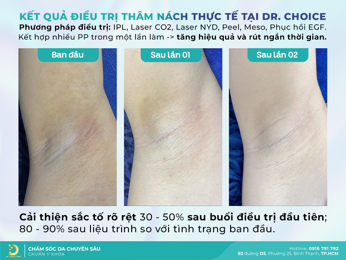 Review Dr. Choice Clinic: Trị Thâm Nách/Bẹn Có Hiệu Quả Không? 1