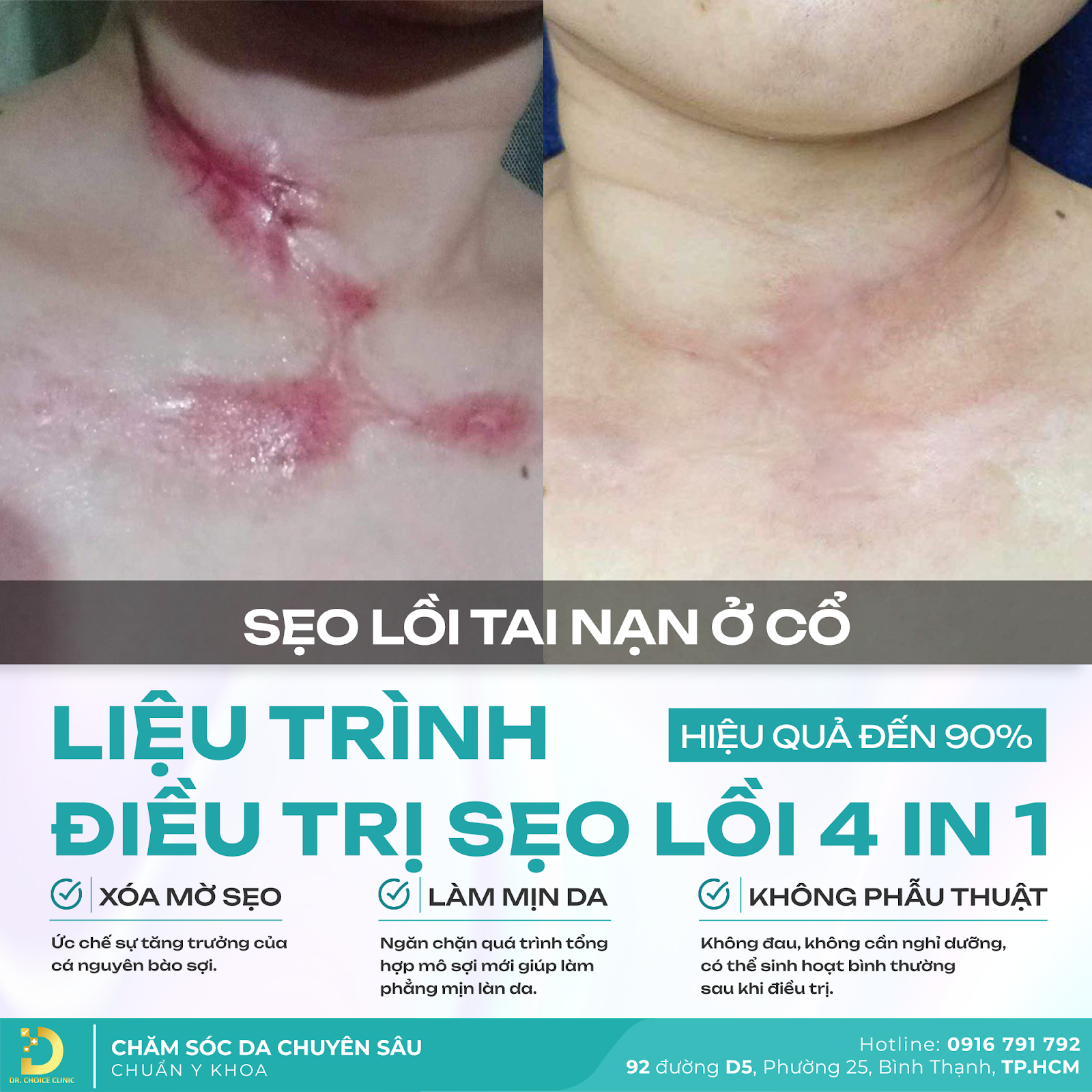 Từ A - Z Về Điều Trị Sẹo Lồi Tại Dr. Choice Clinic 1